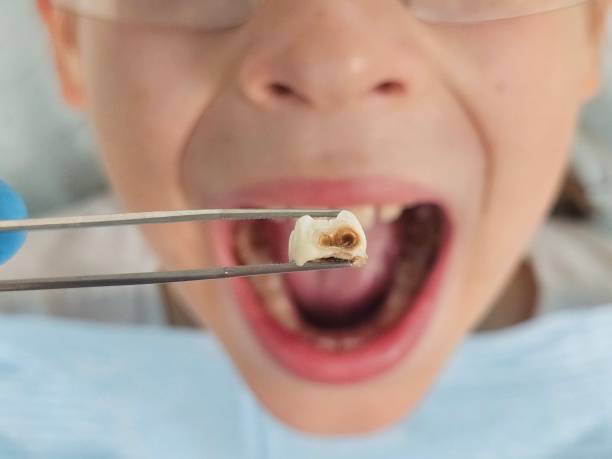 Best Dentist for Tooth Abscess  in Rshfield Hills, MA